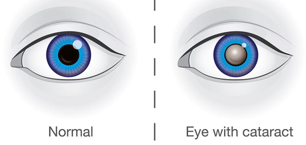 Cataract Awareness.JPG